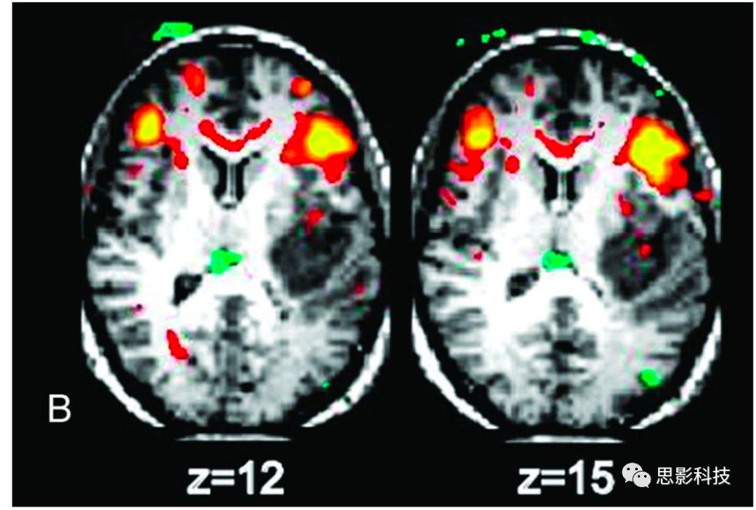 Magnetic Resonance Imaging:白质fMRI及静息态功能连接 - 知乎