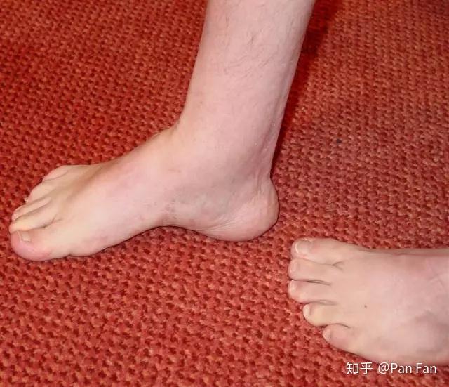 二,足背/足弓高