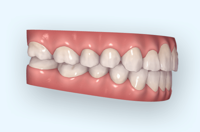 牙弓/颊廊- 覆- 中线- 尖牙的转矩- 切牙垂直向90度- 牙齿的轴