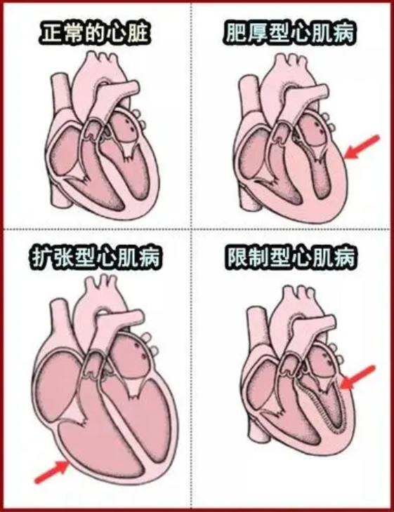 先天性心脏病,如室间隔缺损 (vsd) - 出生时心脏上有一个洞限制性心