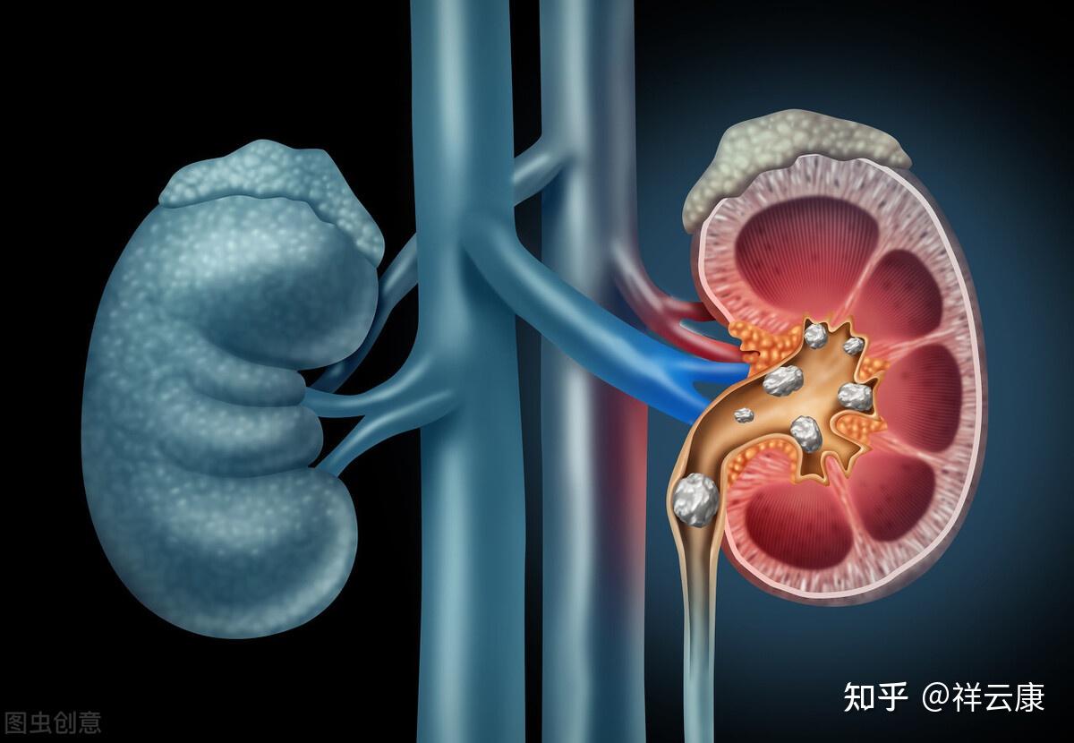 白色马桶帮您发现可疑症状，一文读懂尿路上皮癌如何治疗 - 知乎