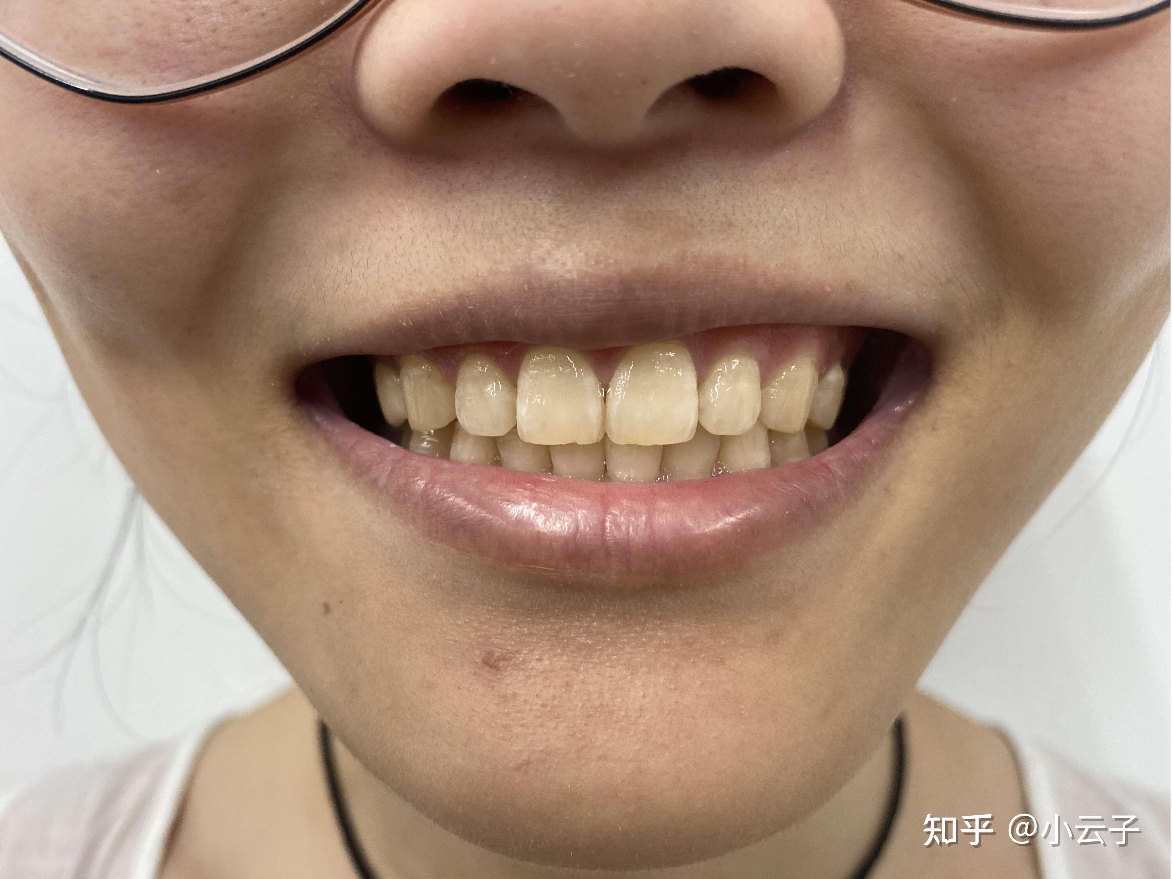 牙齿泛黄,用什么牙膏祛牙黄效果好?不想去美白牙齿