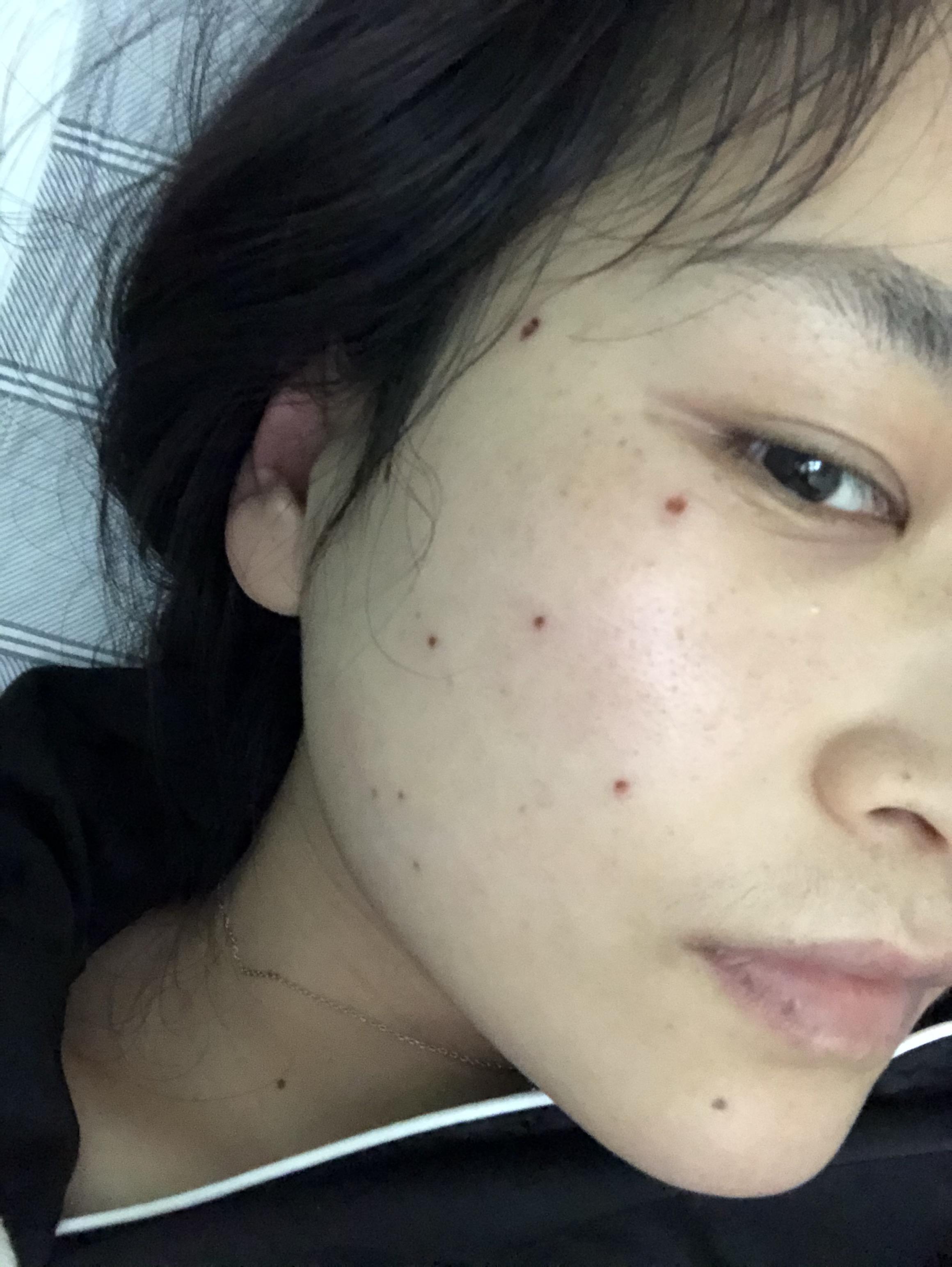 祛痣记录,集美们冲鸭