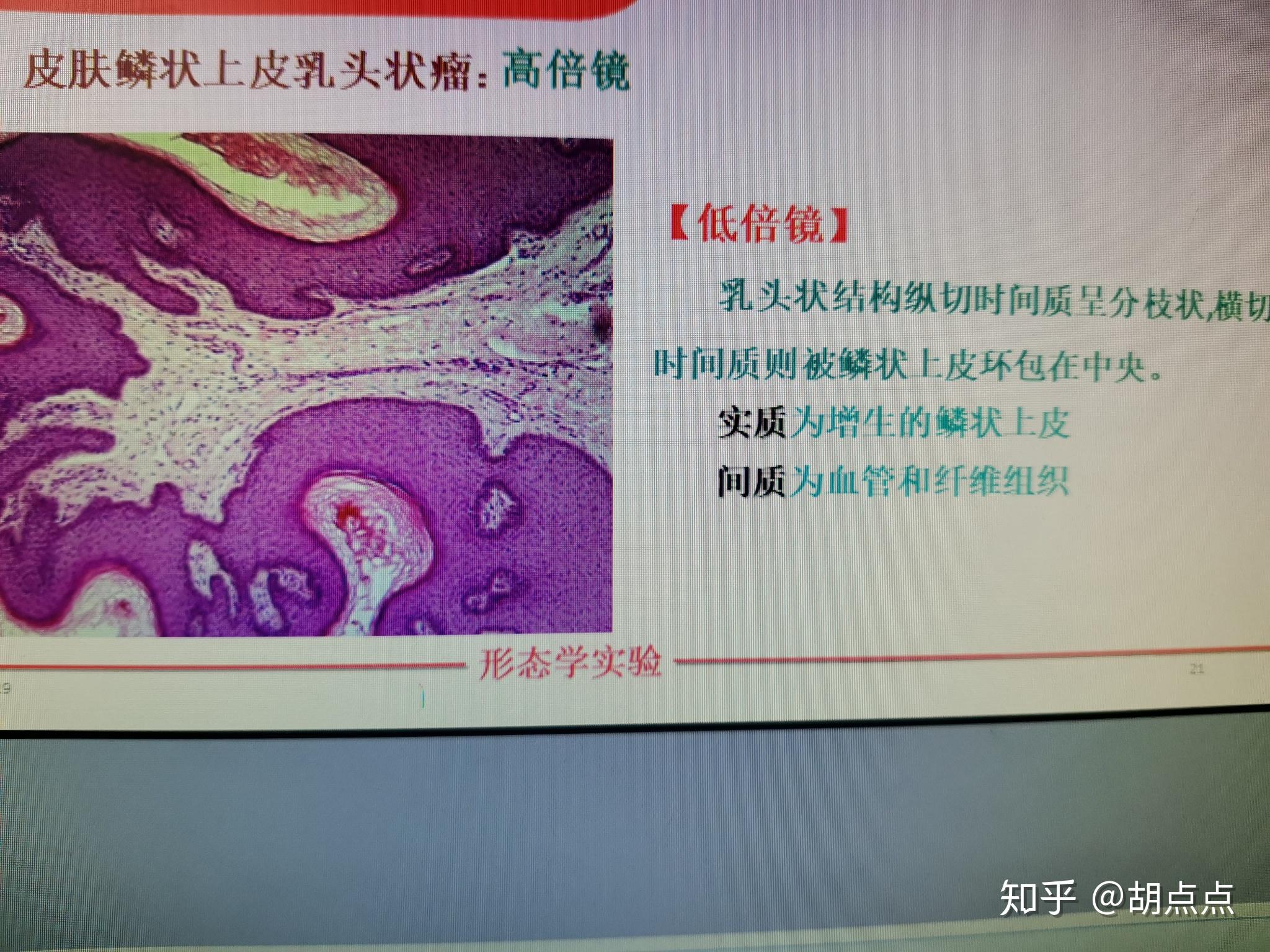 鱗狀上皮乳頭狀瘤高分化鱗狀細胞癌低分化鱗狀細胞癌直腸腺癌平滑肌瘤