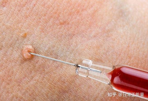 那么,男人感染hpv的风险因素都有那些呢?