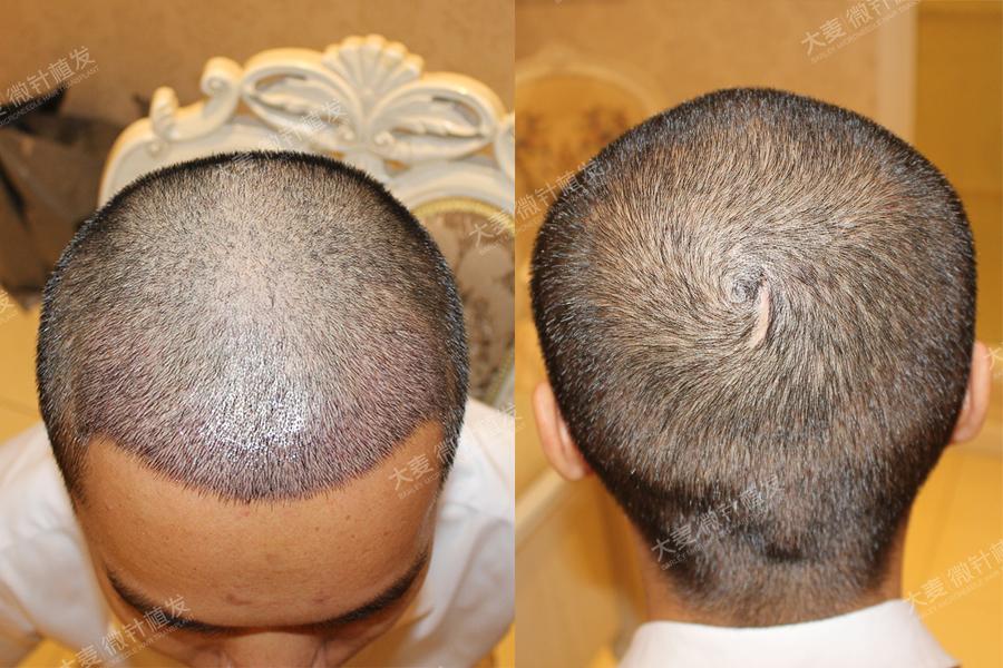 发友分享丨植发2500单位8个月后效果长这样