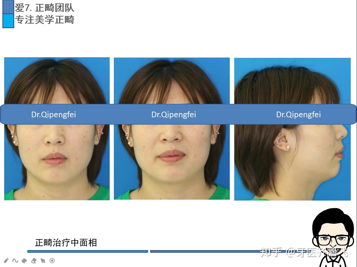 矫正后姑娘的牙齿排齐,咬合恢复正常,开唇露齿问题解决,唇部肌肉明显
