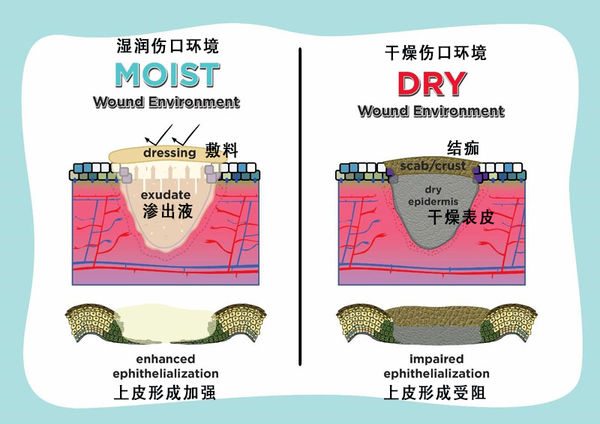 99%的人依然不知道什么叫「湿性愈合」，所以伤口好得贼慢还留疤- 知乎