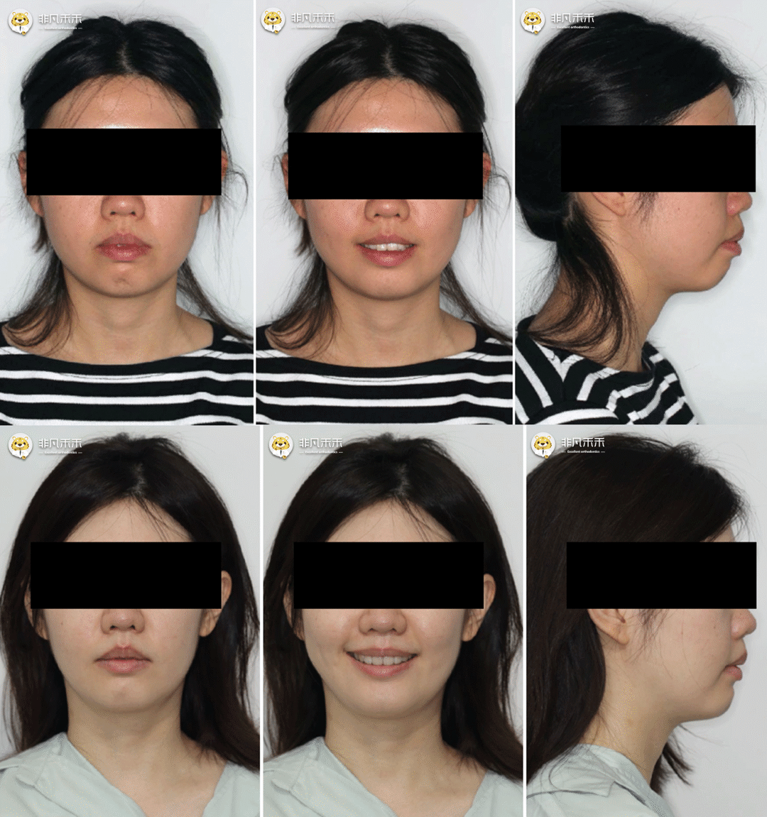 双侧磨牙偏近中关系,矫治主要目标是内收上下颌,改善嘴突,前伸颏部