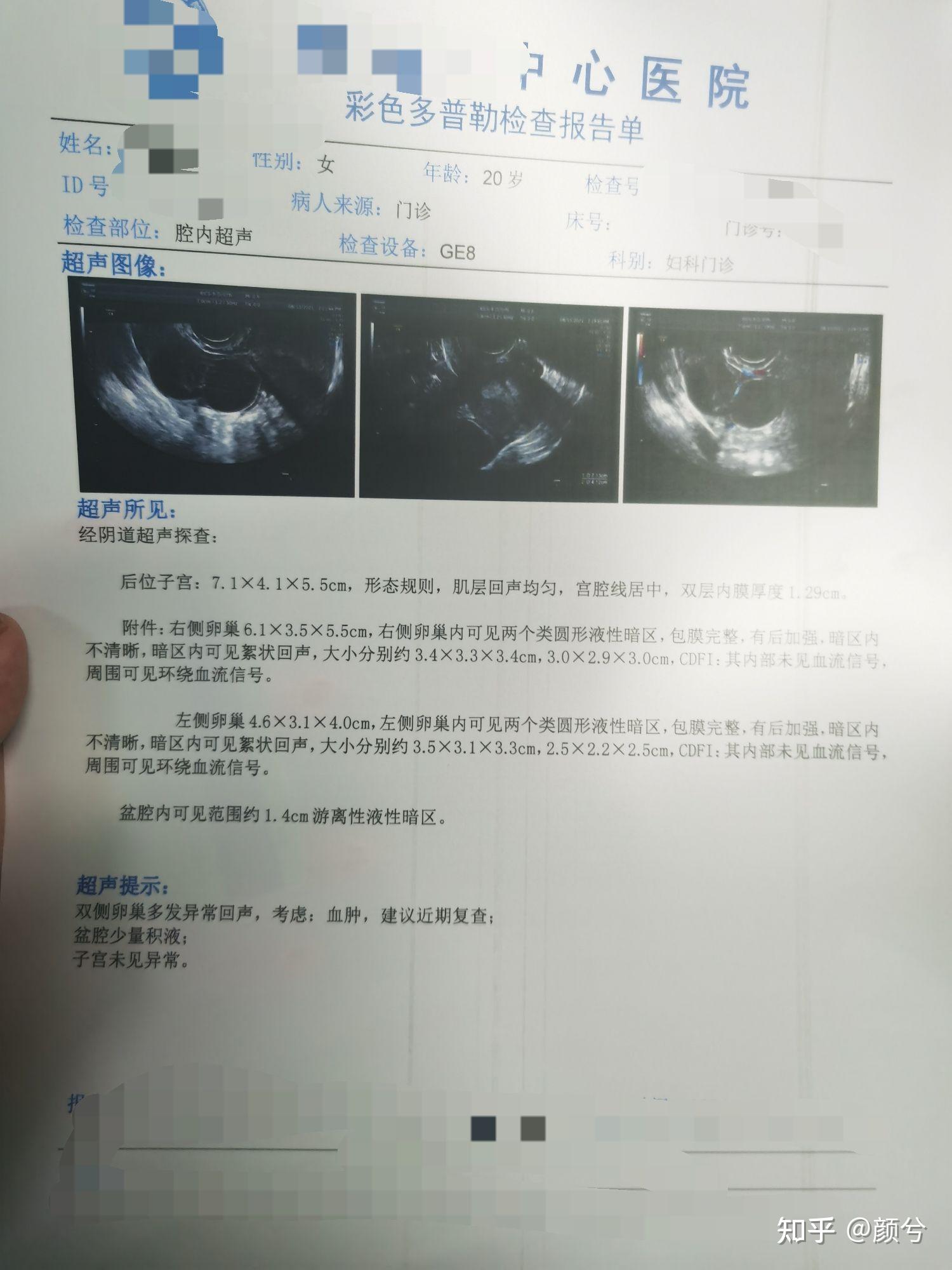 紧急避孕药避孕失败的宫外孕经历