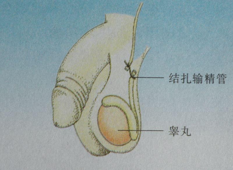 男人结扎后"雄风"就会不在?