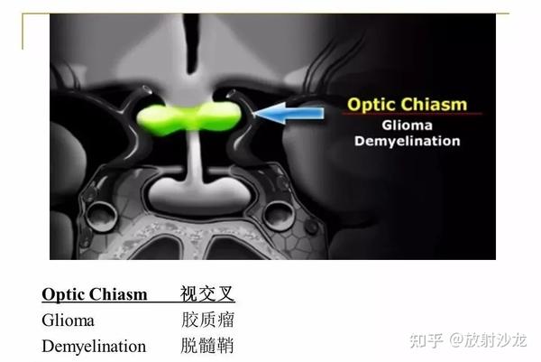 【收藏】蝶鞍及鞍旁区域解剖 - 知乎