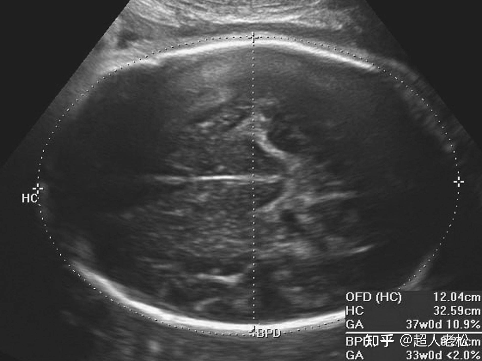 明明白白做超声（二十）：胎儿发育超声评估2—孕龄与中晚期测量 - 知乎
