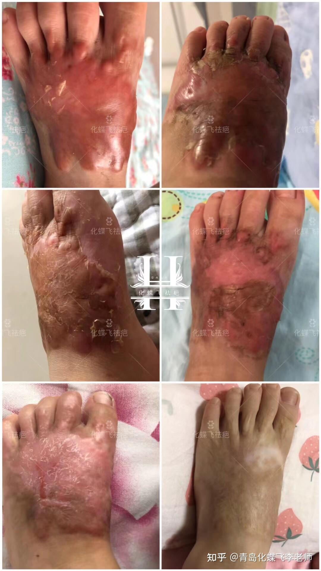 宝宝脚丫重度烫伤增生疤痕
