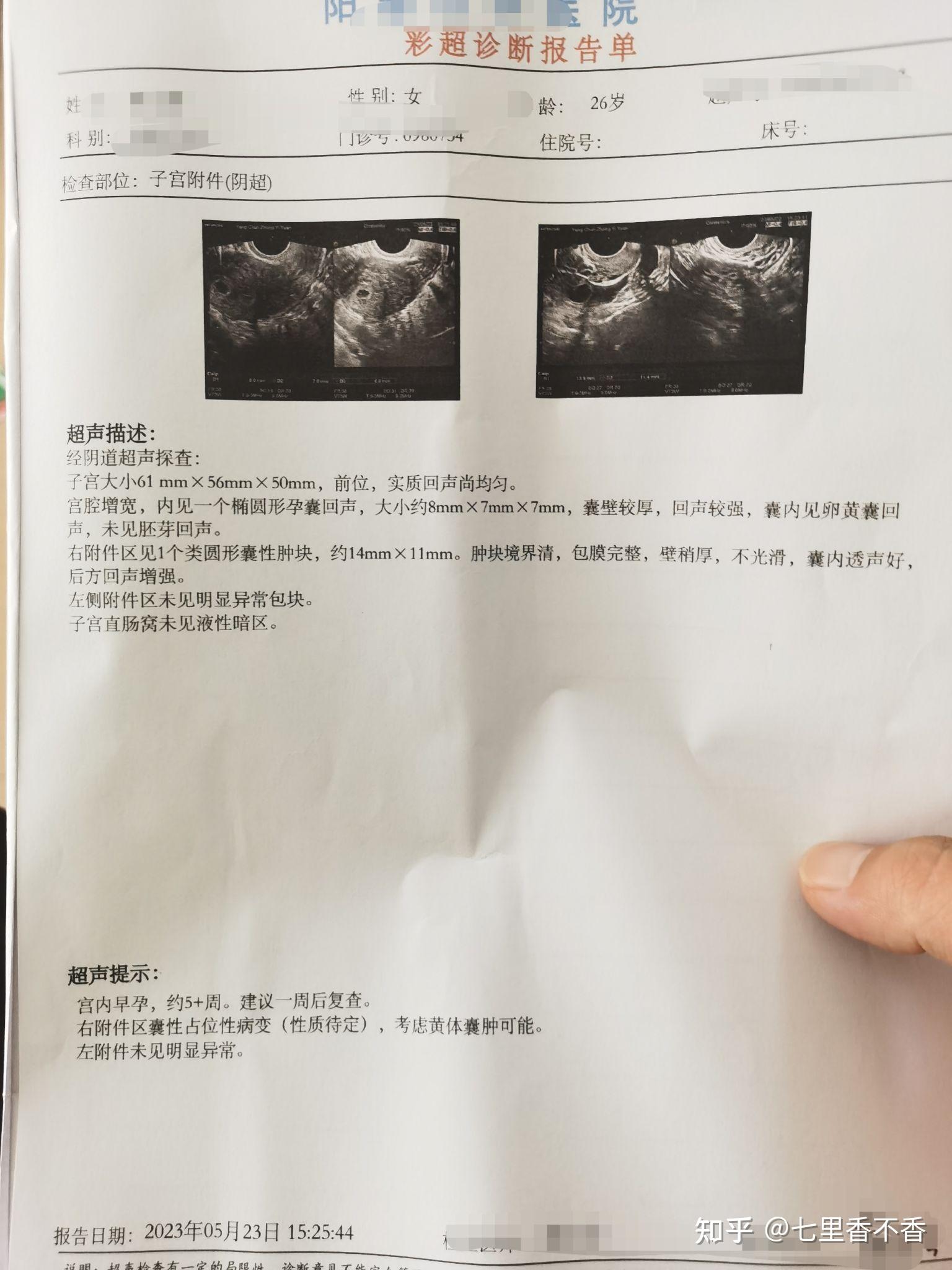 双侧重度精索静脉曲张手术半年效果 - 知乎