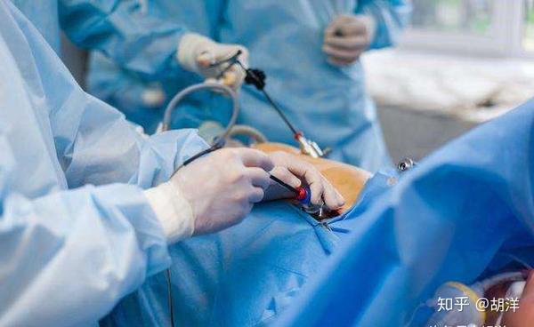 切除胆囊对人体有什么影响 胆囊是不是一个人体可有可无的器官 知乎