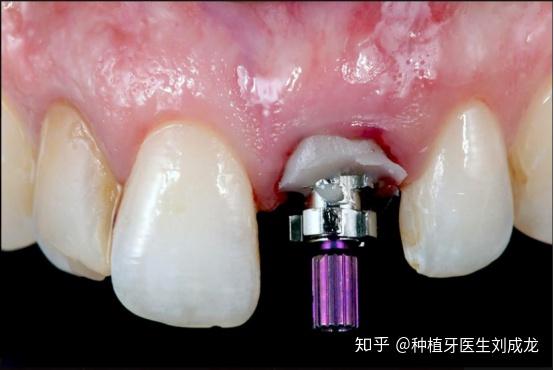 straumann03 blt联合variobase03基台进行即刻种植即刻修复拔牙后