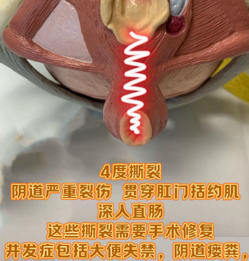 顺产阴道撕裂的四个等级 #十顺九裂