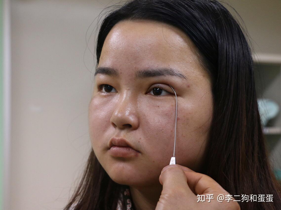 成都第一厚双眼皮割成这样简直是个奇迹了