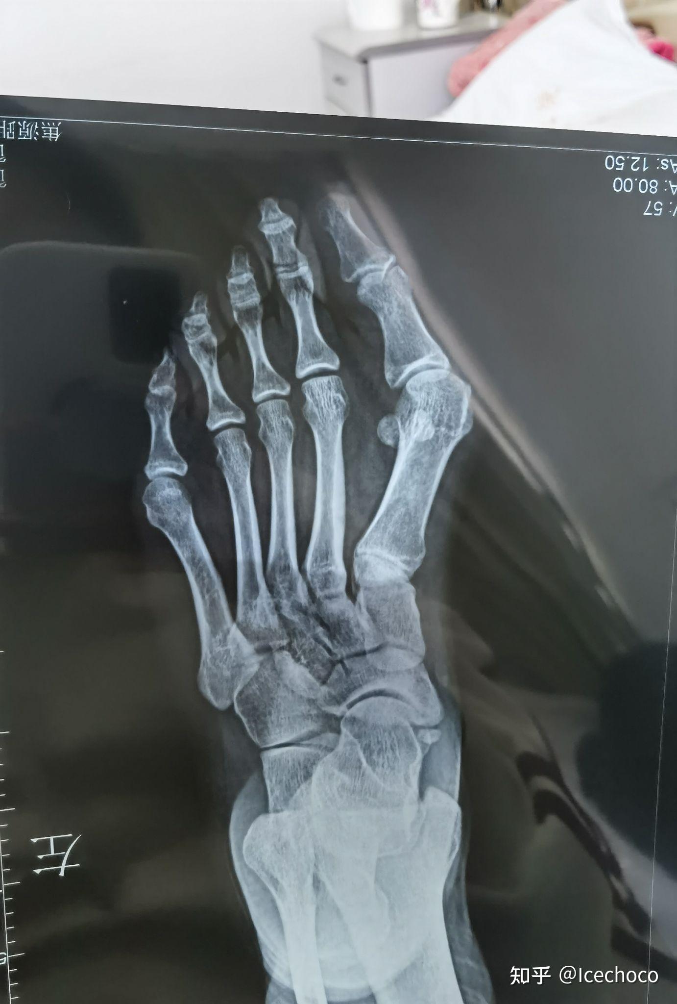 姑且记录一下自己的拇外翻手术恢复史