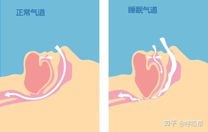 什么样的人容易打呼噜?打鼾的人请对号入座! - 知乎