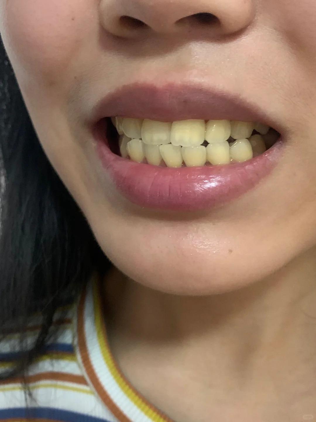 时间长了,牙齿越来越黄,怎么刷都刷不掉,还有很强烈的异味