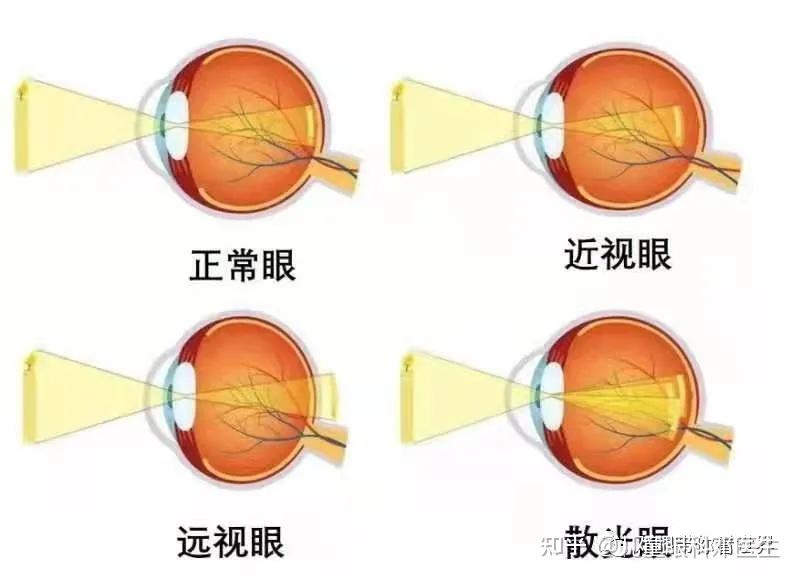 从一例眯眼说起——散光