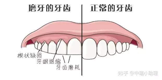 切牙孔的表面标志位于图片