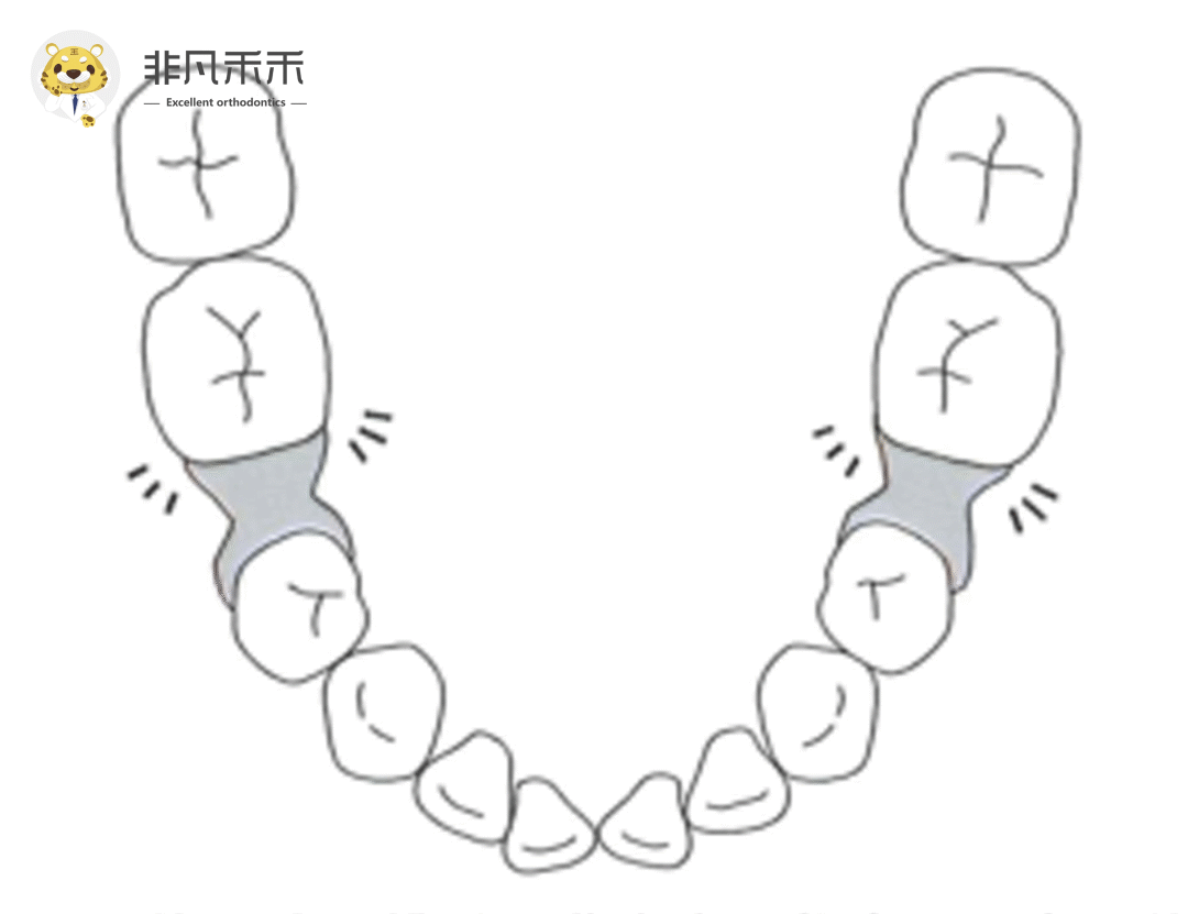 图1-2-33 下颌第一磨牙远中舌根-基础医学-医学