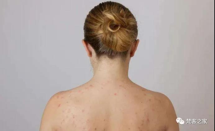 皮肤管理后背痘痘长不停▏那是你还没有看过这一篇