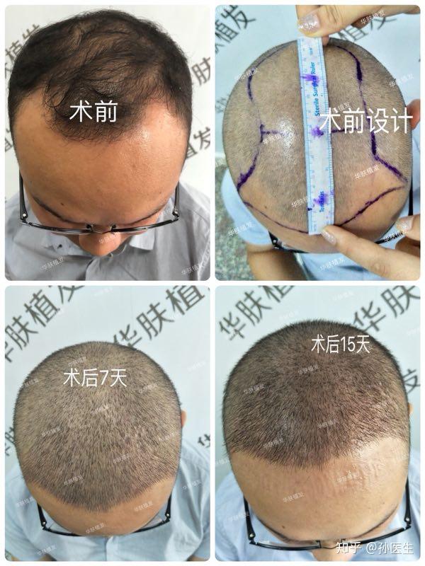 术前术后对比