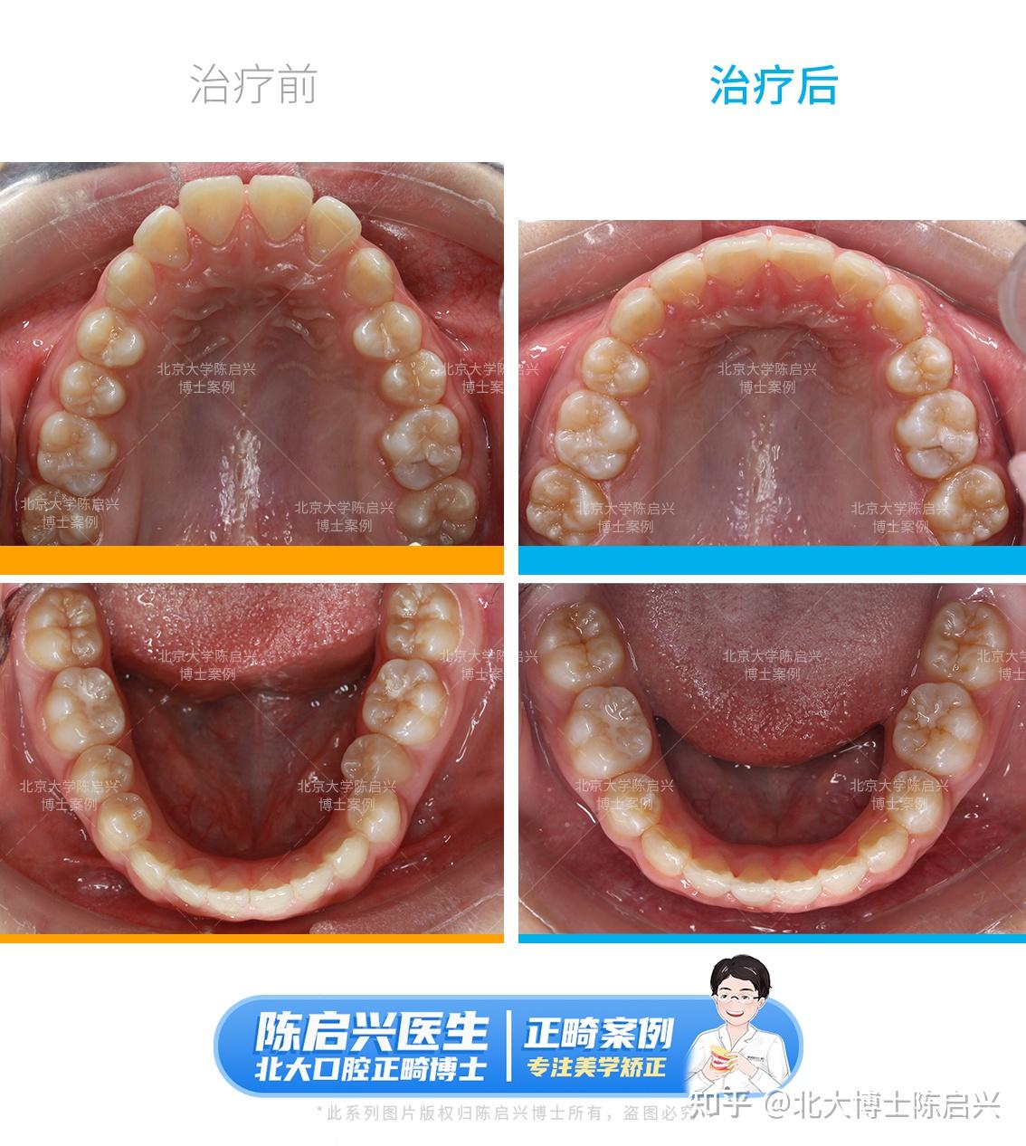 Ⅲ度深覆盖 门牙缝大矫正案例