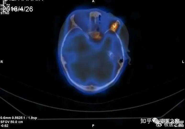 SPECT/CT图像融合技术的应用 - 知乎