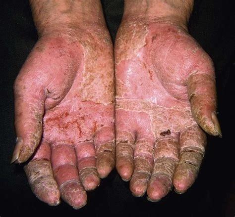 手部干燥开裂怎么办