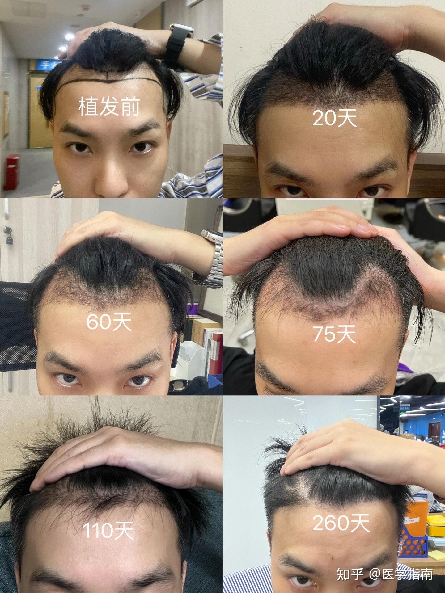 哪家的植发技术(哪家植发性价比高)
