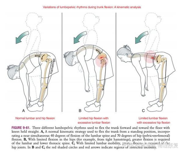 弯腰痛、弯腰受限,问题不在腰椎,要注意这里! - 知乎