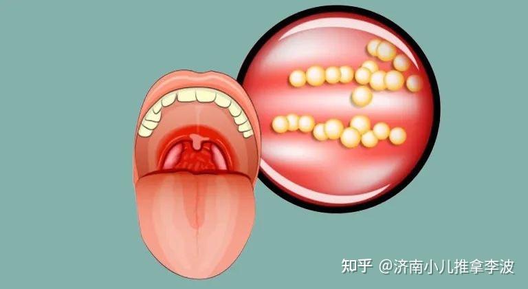 小儿推拿杨晓:小儿急性化脓性扁桃体炎的症状,危害,治疗及预防