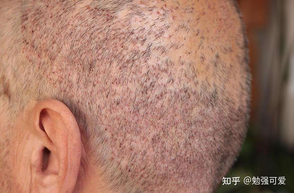 南宁发之友植发失败(植发发友植发经历论坛)