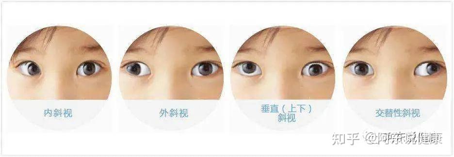 小孩子眼睛老是斜着看东西是怎么回事（宝宝斜眼怎么样纠正） - 知乎