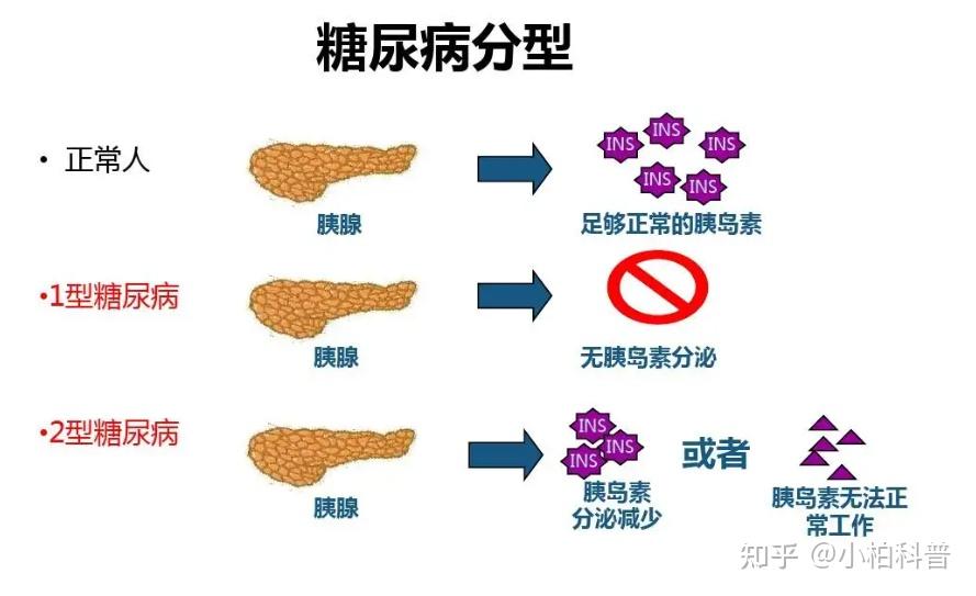 糖尿病的起因 zhuanlan.zhihu.com