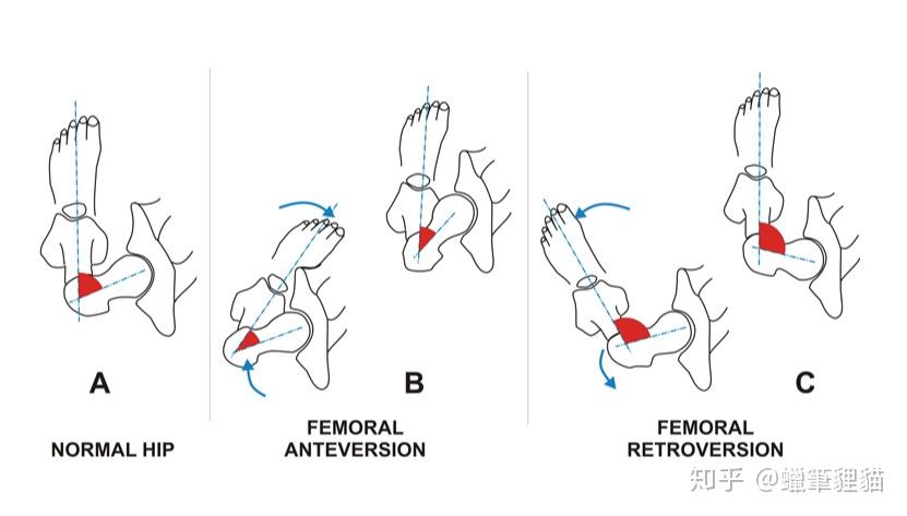 舞蹈中总是趴不下去小青蛙有可能是股骨前倾