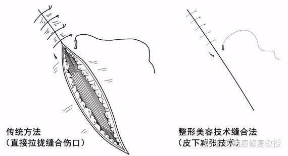普通缝合和美容缝合差距竟然这么大 - 知乎
