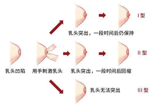 【医学科普】女性乳头凹陷诊断及治疗