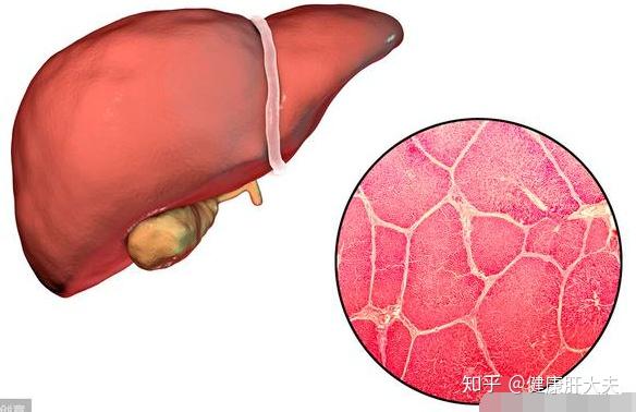 肝纖維化與肝硬化有什麼不同肝纖維化能實現逆轉嗎