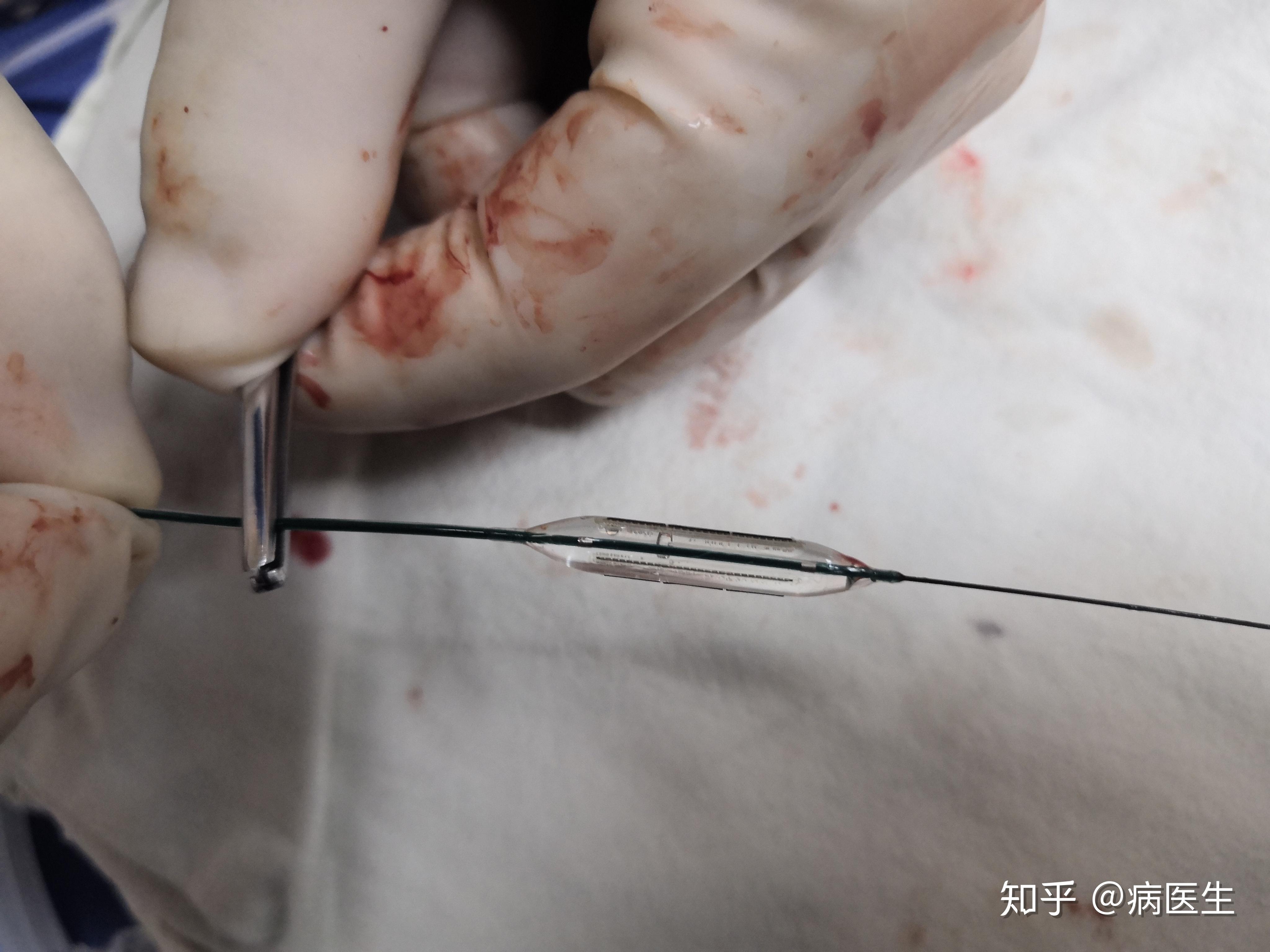 难治性吻合口动脉狭窄的切割球囊治疗