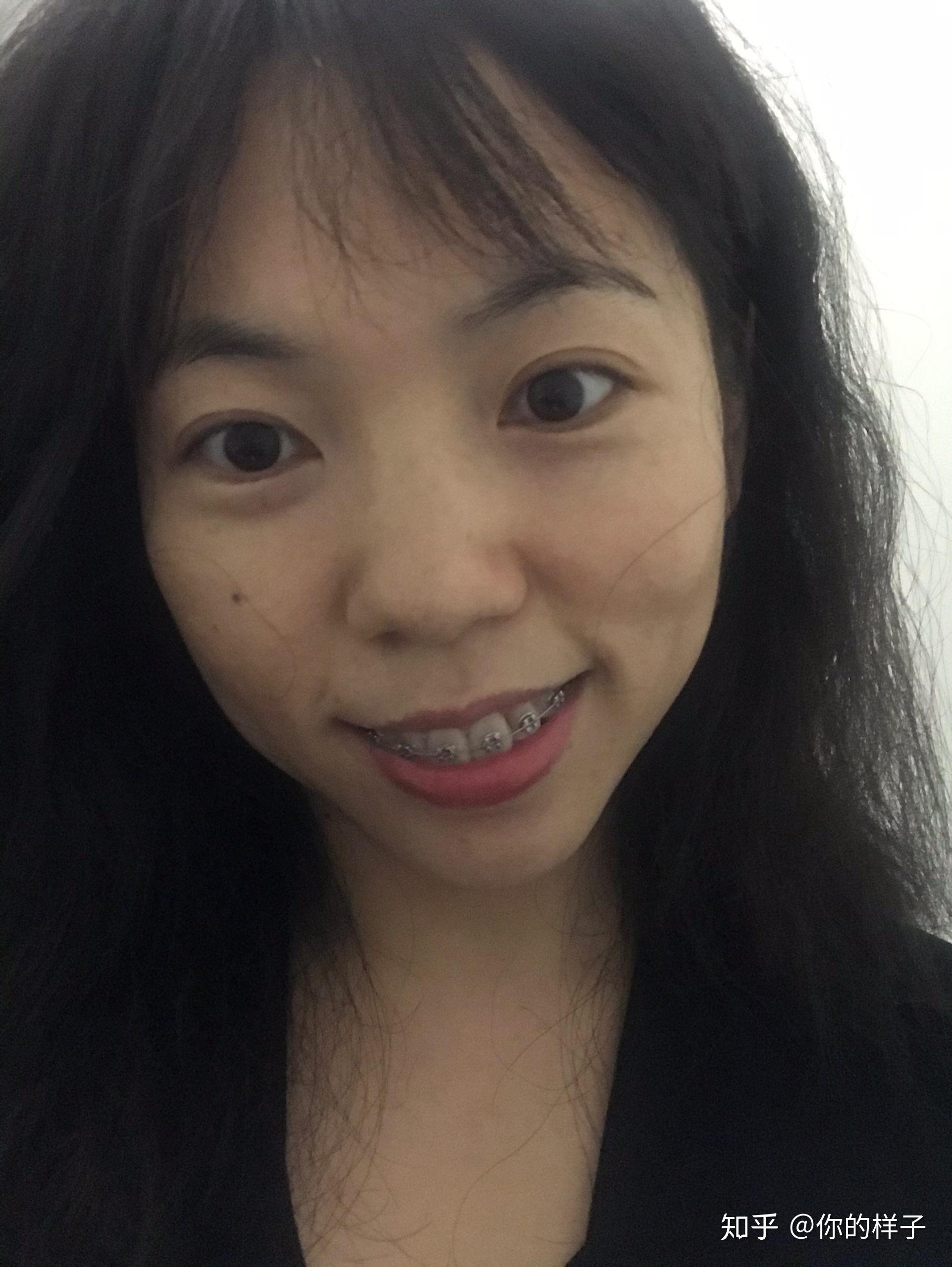 大龄女青年骨性嘴凸下巴后缩深覆合