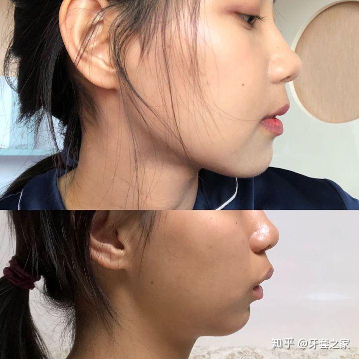 正畸科普｜下巴后缩怎么办，解决方法看这里 - 知乎