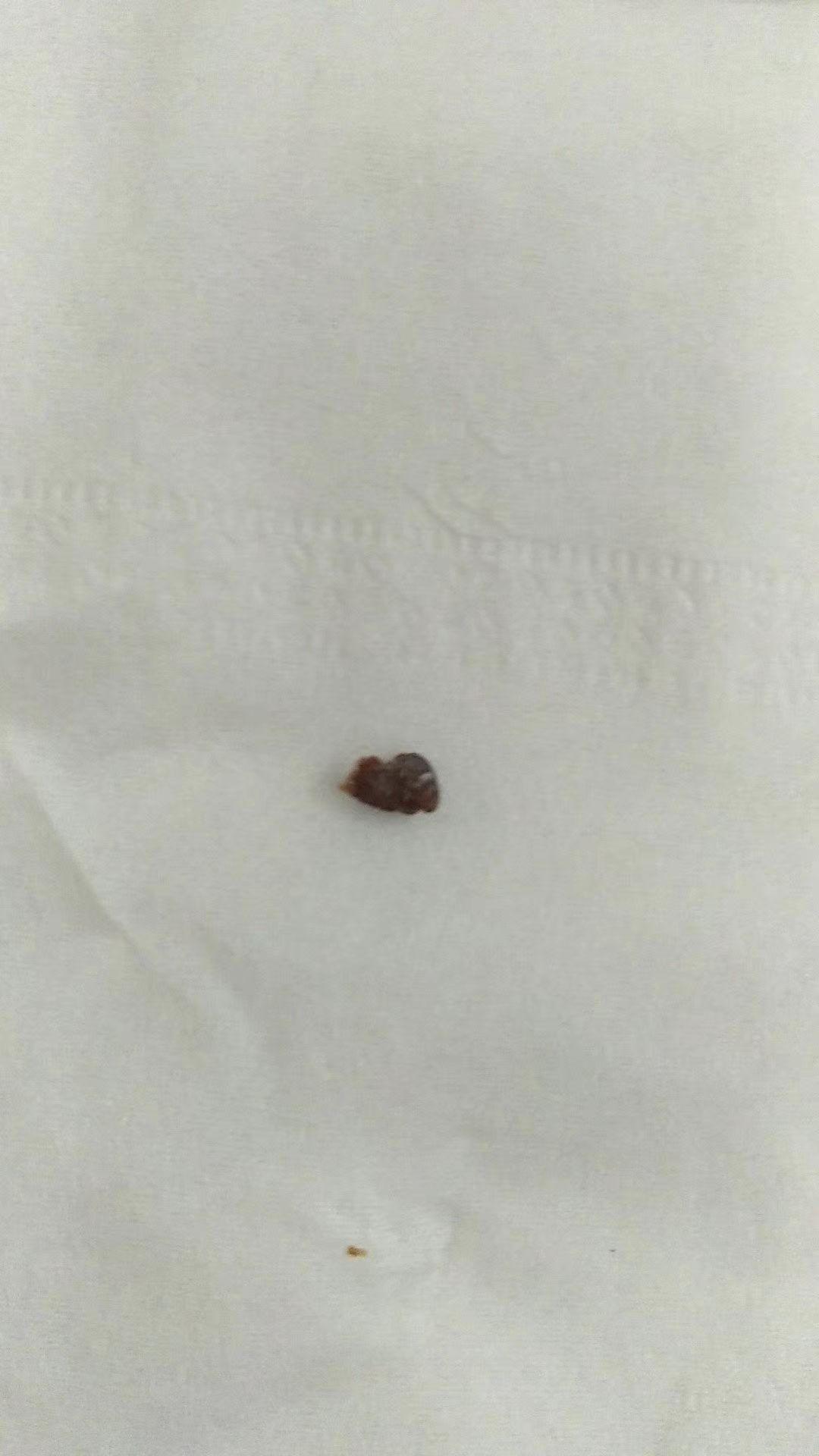 肾结石一般多久会疼 v2-e2356b4de4edb5ba209f0e422c99bfde_r.jpg