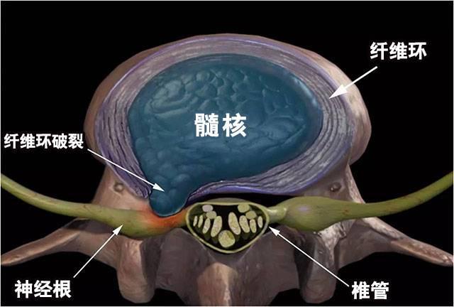 腰椎间盘突出全解析 知乎 