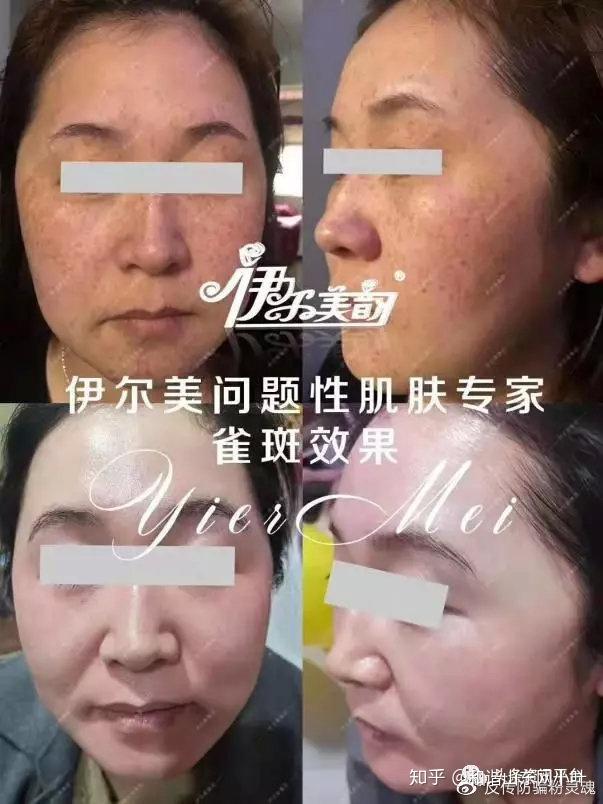来看看这个伊尔美韵,这个品牌的产品在加盟商的朋友圈中,号称专业祛斑